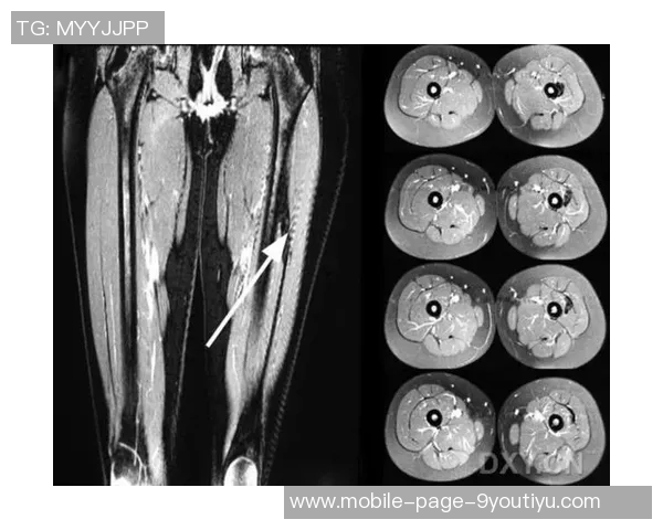 李磊右大腿后群肌肉拉伤及肌筋膜炎I的伤情报告分析与康复建议